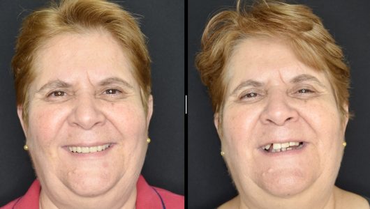 Antes e Depois Protocolo