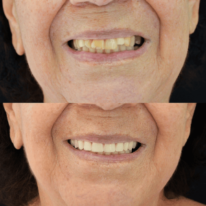 Antes e Depois Protocolo