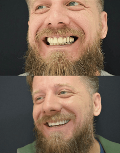 Antes e Depois Protocolo